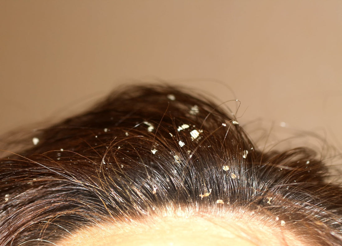 The Lowdown: Dandruff - What is it & what are the causes? - Indie